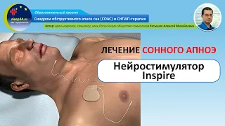 #49: Лечение остановок дыхания во сне нейростимулятором Inspire | СОАС и СИПАП-терапия