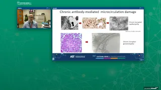 Chronic Antibody Mediated Rejection