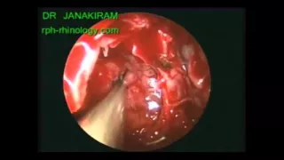 Optic Nerve Decompression Left [Ear, Nose and Throat]