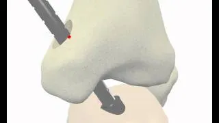 Técnica artroscópica de tobillo - Animación