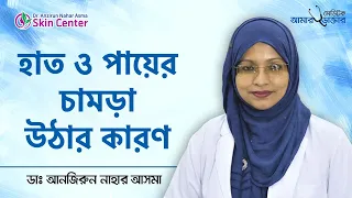 হাত ও পায়ের চামড়া ওঠার প্রতিকার - Hand skin rashes