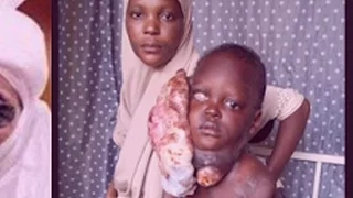 6 Year Old Nigerian Boy Suffering From Rare Form Of  Facial Cancer