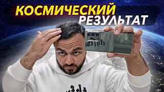 Пересадка волос ДО и ПОСЛЕ / Отзыв пациента GeoGRAFT #79