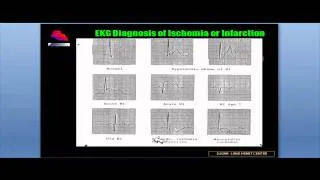 EKG-MI-PART-3 BY NIK NIKAM, MD, MHA