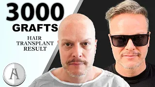 Most Natural Hair Transplant in Turkey |3000 GRAFTS| Injerto Capilar Más Natural en Turquía | AISHA