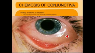 ENDOPHTHALMITIS SIMPLIFIED