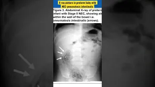 X-ray picture in preterm baby with NEC-pneumatosis intestinalis #NEC #necrotisingenterocolits