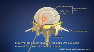 О лазерной операции