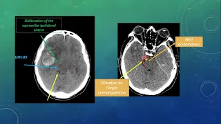 interprétation facile de tdm cérébral (aux urgences)