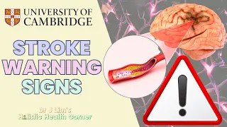 Early WARNING Signs of STROKE You NEED to Know | Cambridge Doctor Explains