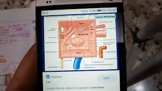 CHRONIC SUPPURATIVE OTITIS MEDIA part 1 general explanation with types  must watch to get it