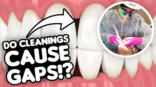 Can Dental Cleanings Cause Gaps Between Teeth? (Black Triangles Explained)