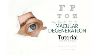 A Wet Macular Degeneration Treatment Tutorial