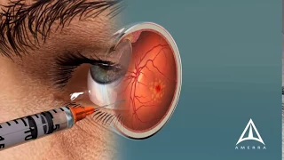 How Macular Degeneration Affects Your Vision - 3D animation