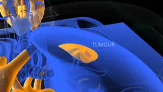 PET Scan animation