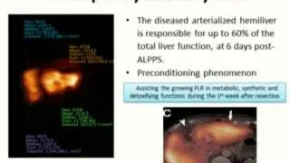 ALPPES -Associating Liver Partition and Portal VeinLigation