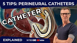 5 TIPS: PERINEURAL CATHETERS - Crash course with Dr. Hadzic
