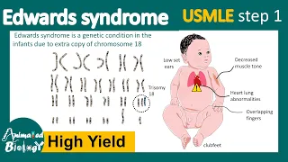 Edward Syndrome | Symptoms of Edward Syndrome | Cause of Edward Syndrome | Trisomy 18 | USMLE