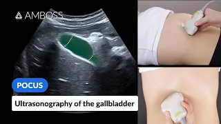 Point of Care Ultrasound of the Gallbladder - AMBOSS Video