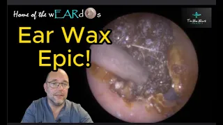 Ear Wax Epic - 164 #ear #earwax #earwaxremoval #earcleaning #asmr #asmrearwax #satisfying