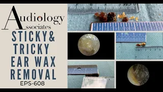 STICKY & TRICKY EAR WAX REMOVAL  - EP608