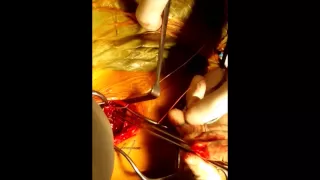 Repair of Direct Head of Rectus Femoris Musculotendinous Junction Tear by Dr HC Chang