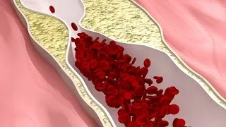 ¿Cómo y por qué ocurren los derrames cerebrales?