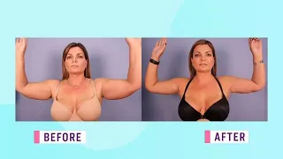 The new way to perform an arm lift surgery