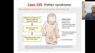 Case 155 potter syndrome vs potter sequence or phenotype,  multidystic dysplastic kidney, PKD