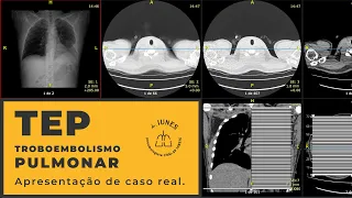 CASO REAL. Tromboembolismo Pulmonar (TEP). Apresentação de um caso real.