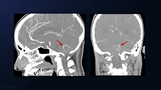 Suboccipital Craniotomy and Telovelar Approach for P4 PICA Aneurysm Clipping