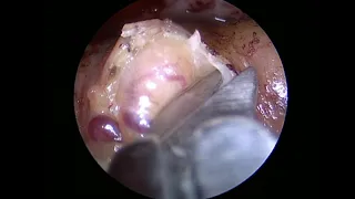 Orbit 3 Intraconal cavernous angioma Transorbital approach