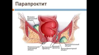 Парапроктит