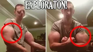 El Hulk ruso cambia el Synthol por implantes de silicona para agrandar sus músculos