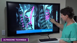 Cervical Stenosis: Traditional Technology vs. Newer Ultrasonic Technology for Spine Surgery