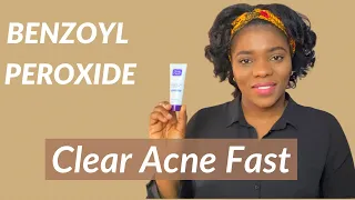 Acne Treatment - How to use BENZOYL PEROXIDE for ACNE | Dr Janet