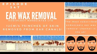 12CM/4.75INCHES OF SKIN REMOVED FROM EAR CANALS - EP 347