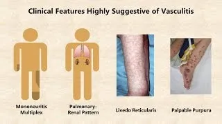 Vasculitis - An Overview