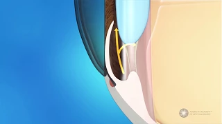 What is angle-closure glaucoma?