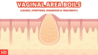 Dealing with Vaginal Area Boils: Tips and Advice for Fast Relief