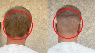 DAS solltest du VOR DER HAARTRANSPLANTATION wissen! Mr. Hairtransplant