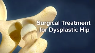 Surgical Treatment for Dysplastic Hip | Cincinnati Children's