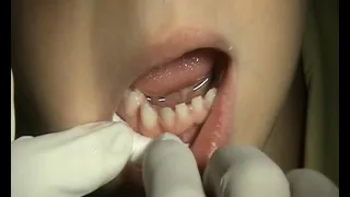 Лечение кариеса временных зубов методом импрегнации серебром (серебрение)