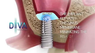 DIVA - Innovative closed sinus lift technology