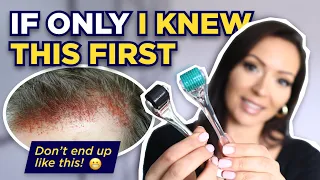 The Dermaroller: Watch This BEFORE Microneedling! (What I wish I knew Before I Started Dermarolling)