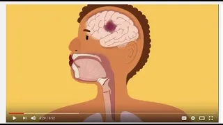 Déglutition et communication après un AVC- Swallowing and Communication after Stroke (French)