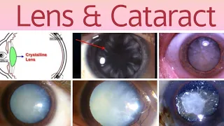 Lens & Cataract 6 | Aphakia