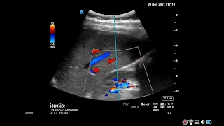 How to... Obtain a Renal Vein Waveform