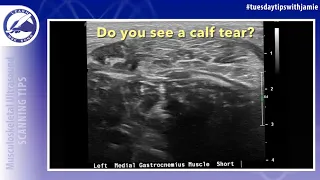 Technique for visualizing a calf tear on ultrasound