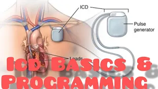 #ICD basics - #Pacemaker  #Implantablecardioverterdefibrillator #Defibrillator #drnarendrakumar